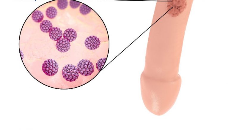 Sùi mào gà có thể xuất hiện ở quy đầu, thân hoặc gốc dương vật