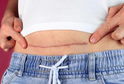 Khuyết sẹo mổ lấy thai có ảnh hưởng gì không là thắc mắc của nhiều phụ nữ