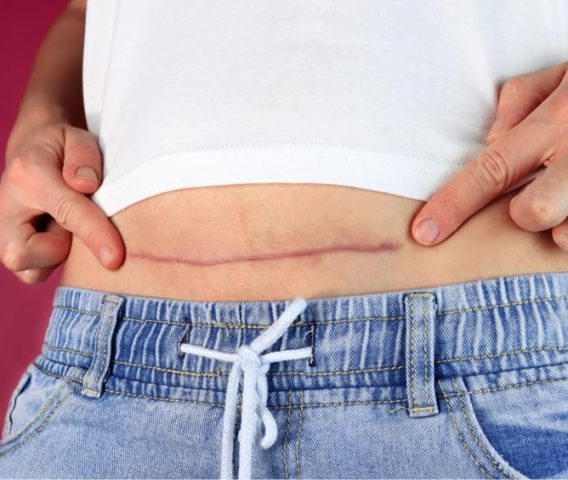 Khuyết sẹo mổ lấy thai có ảnh hưởng gì không là thắc mắc của nhiều phụ nữ