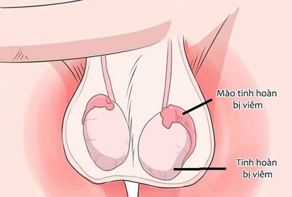 Viêm tinh hoàn sau khi bị quai bị có thể dẫn đến vô sinh ở nam giới