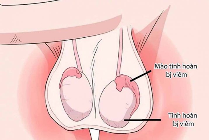 Viêm tinh hoàn sau khi bị quai bị có thể dẫn đến vô sinh ở nam giới