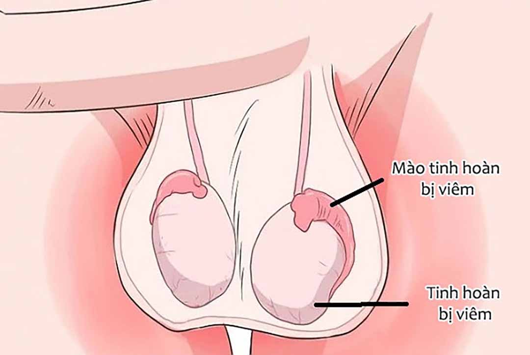 Viêm tinh hoàn sau khi bị quai bị có thể dẫn đến vô sinh ở nam giới