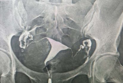 Hình chụp X-Quang tử cung – vòi trứng