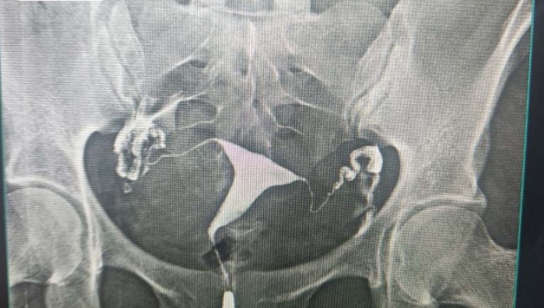 Hình chụp X-Quang tử cung – vòi trứng