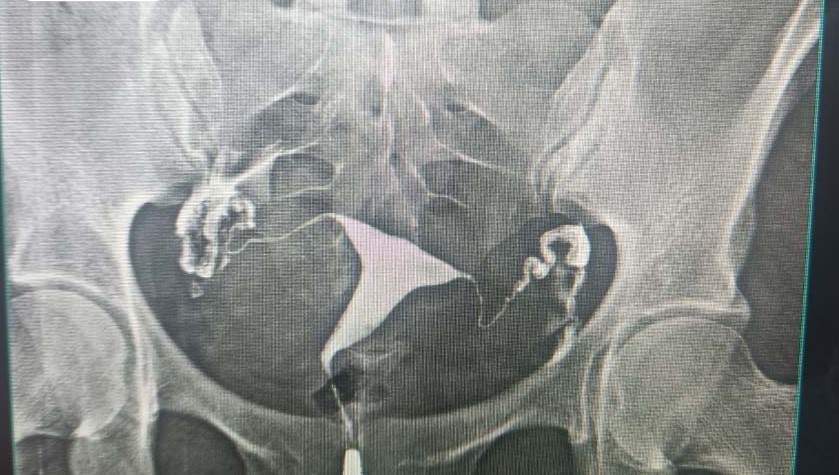 Hình chụp X-Quang tử cung – vòi trứng