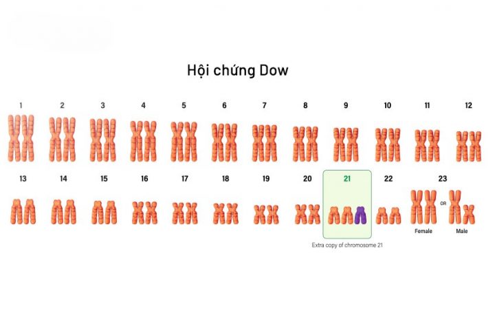 Xét nghiệm NIPT giúp phát hiện ra những bất thường về nhiễm sắc thể của thai nhi một cách chính xác