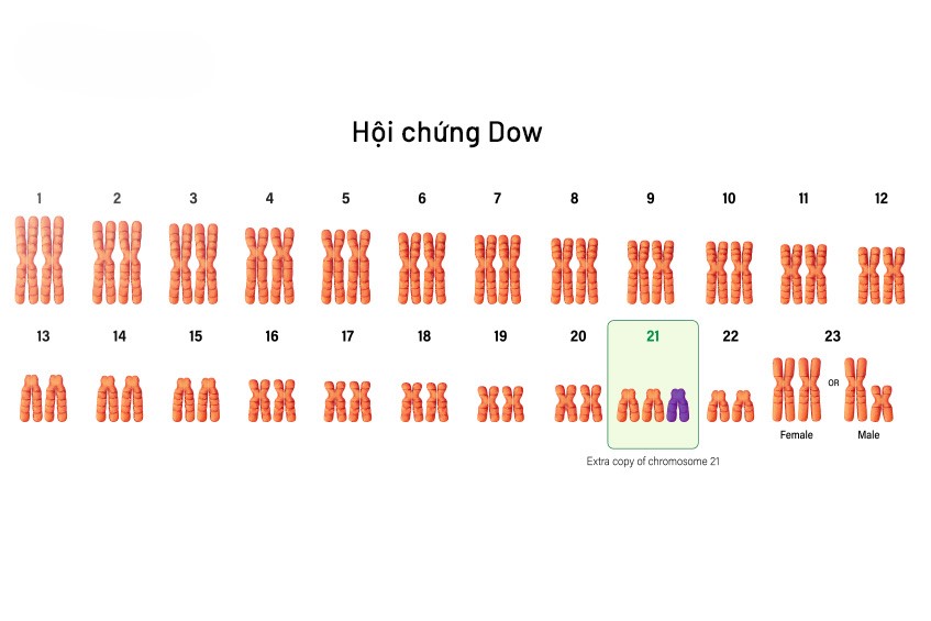 Xét nghiệm NIPT giúp phát hiện ra những bất thường về nhiễm sắc thể của thai nhi một cách chính xác