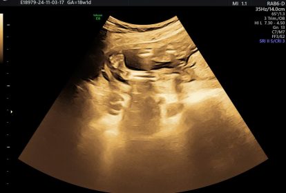 Các dị tật cơ xương khớp gây cản trở nhiều hoạt động của bệnh nhi