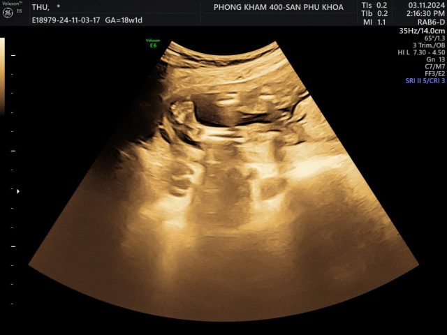 Các dị tật cơ xương khớp gây cản trở nhiều hoạt động của bệnh nhi