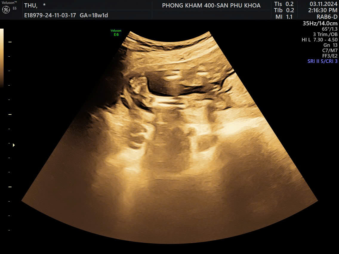 Các dị tật cơ xương khớp gây cản trở nhiều hoạt động của bệnh nhi