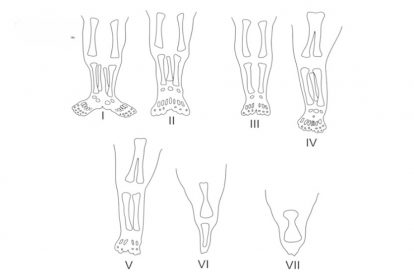 7 loại hội chứng “nàng tiên cá”