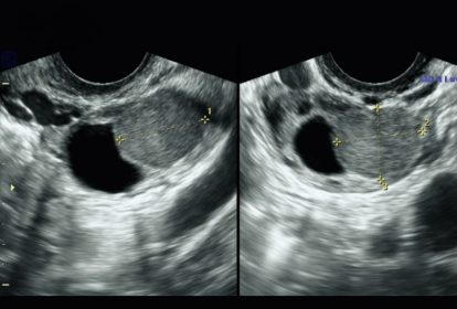 Quá trình siêu âm lạc nội mạc tử cung kéo dài từ 30 phút đến một giờ