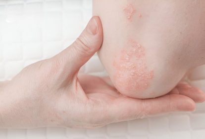 Bệnh xuất hiện dưới dạng những mảng da đỏ, sần sùi, bong vảy, kèm theo cảm giác ngứa ngáy, nóng rát hoặc châm chích gây khó chịu.