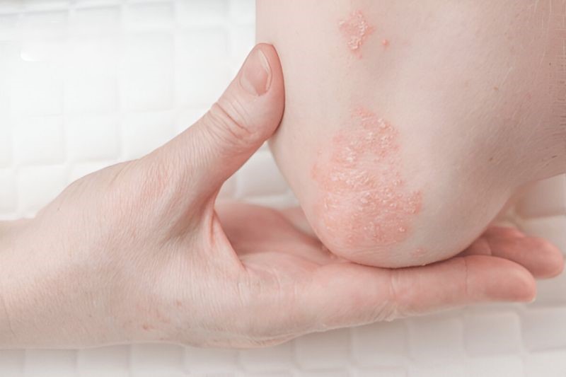 Bệnh xuất hiện dưới dạng những mảng da đỏ, sần sùi, bong vảy, kèm theo cảm giác ngứa ngáy, nóng rát hoặc châm chích gây khó chịu.