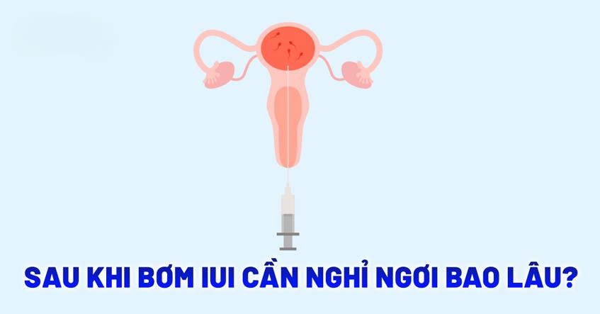 Sau khi thực hiện bơm tinh trùng (IUI), thời gian nghỉ ngơi phụ thuộc vào hướng dẫn của bác sĩ và tình trạng sức khỏe của từng người