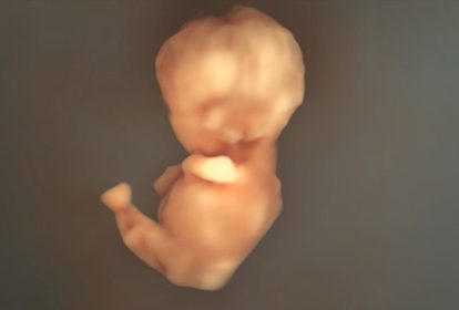 Siêu âm phát hiện thai nhi mắc hội chứng nàng tiên cá