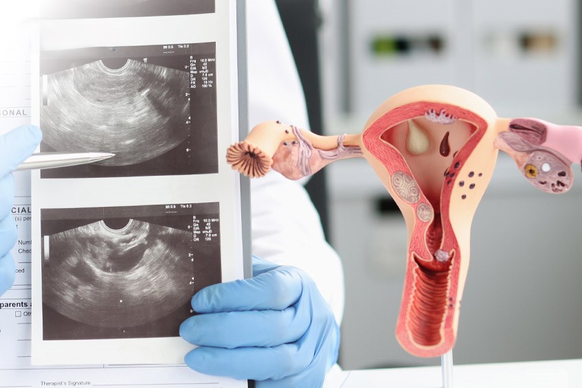 Siêu âm có thể hiển thị mô lạc nội mạc tử cung to và không thể phát hiện nếu kích thước nhỏ