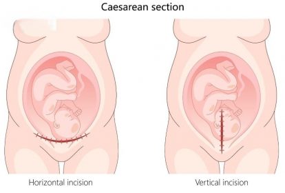 Tần suất xuất hiện khuyết sẹo mổ lấy thai đang có xu hướng tăng lên do tỷ lệ sinh mổ ngày càng tăng
