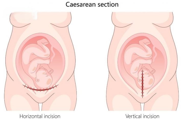 Tần suất xuất hiện khuyết sẹo mổ lấy thai đang có xu hướng tăng lên do tỷ lệ sinh mổ ngày càng tăng