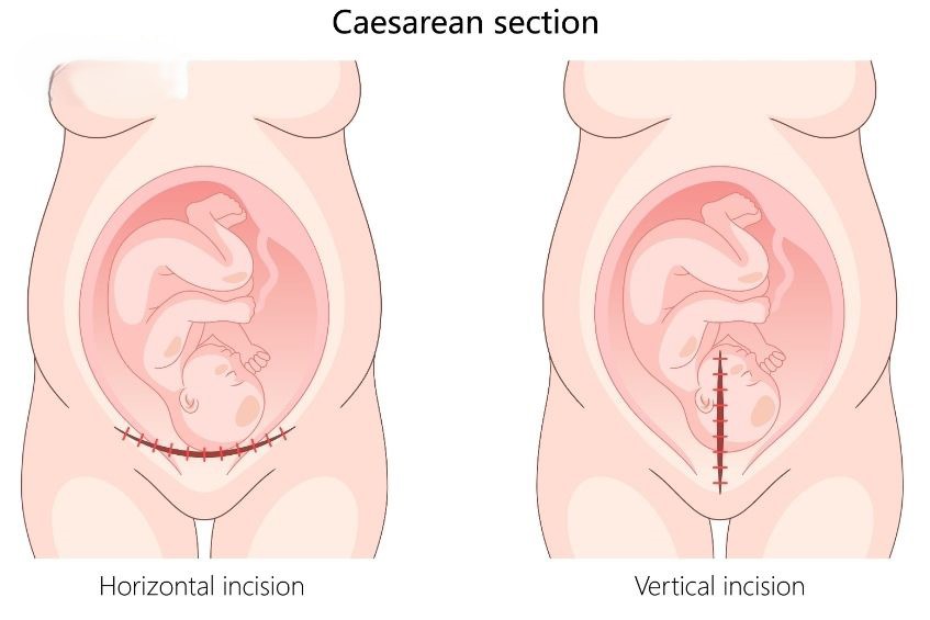 Tần suất xuất hiện khuyết sẹo mổ lấy thai đang có xu hướng tăng lên do tỷ lệ sinh mổ ngày càng tăng