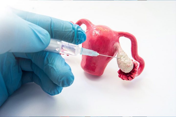 Tuỳ vào nguyên nhân mà bác sĩ sẽ chỉ định phương pháp điều trị rối loạn phóng noãn cụ thể