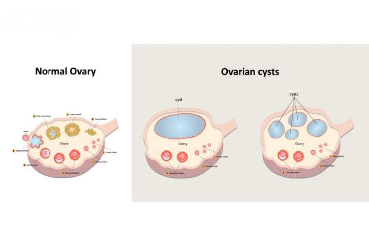 U bì buồng trứng (u quái giáp buồng trứng) phát triển từ các tế bào mầm chưa phân hóa hoàn toàn.