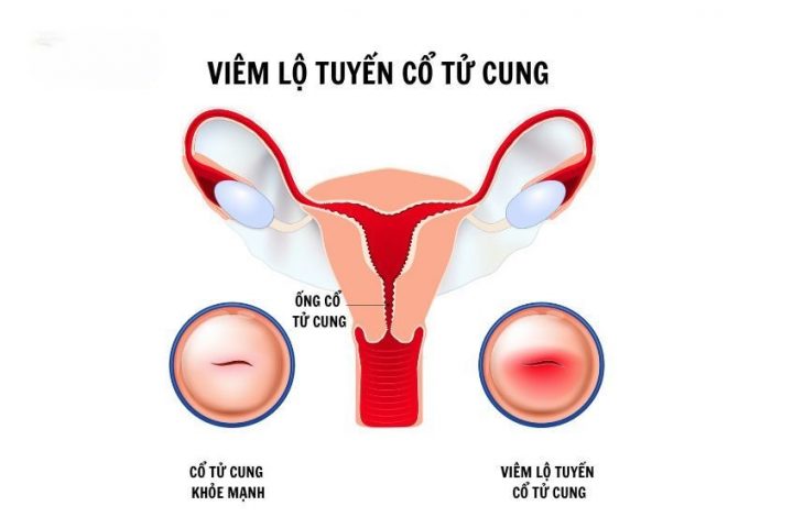Phụ thuộc vào thời gian, phác đồ điều trị và các yếu tố liên quan khác