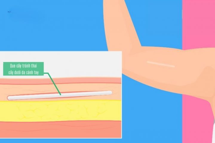 Que cấy tránh thai được cấy dưới da mặt trong cánh tay không thuận của phụ nữ