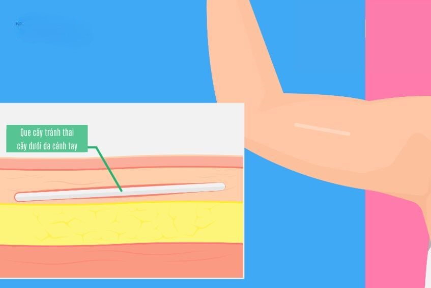 Que cấy tránh thai được cấy dưới da mặt trong cánh tay không thuận của phụ nữ